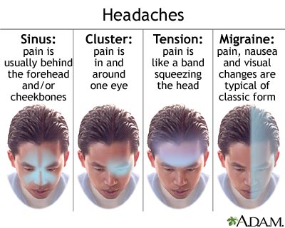 migraine-symptoms1
